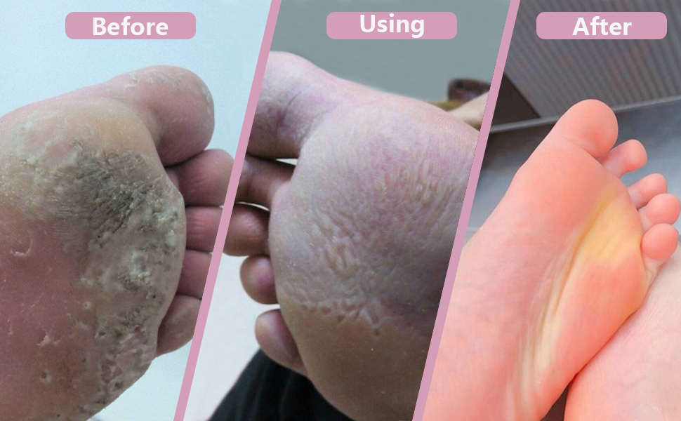 Foot Callus Remover for FootHealth