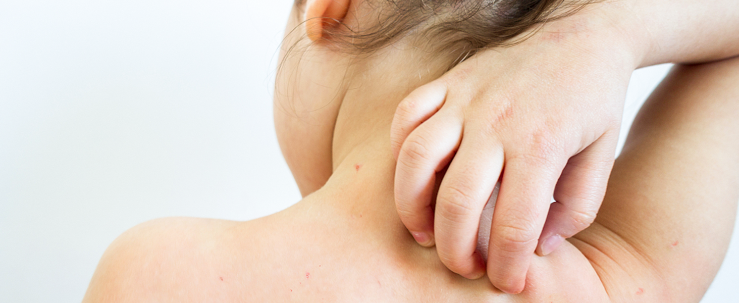 Eczema Cream