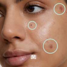 Primo piano del viso di una persona con pennarelli circolari che evidenziano aree specifiche, indicando possibilmente problemi cutanei o zona