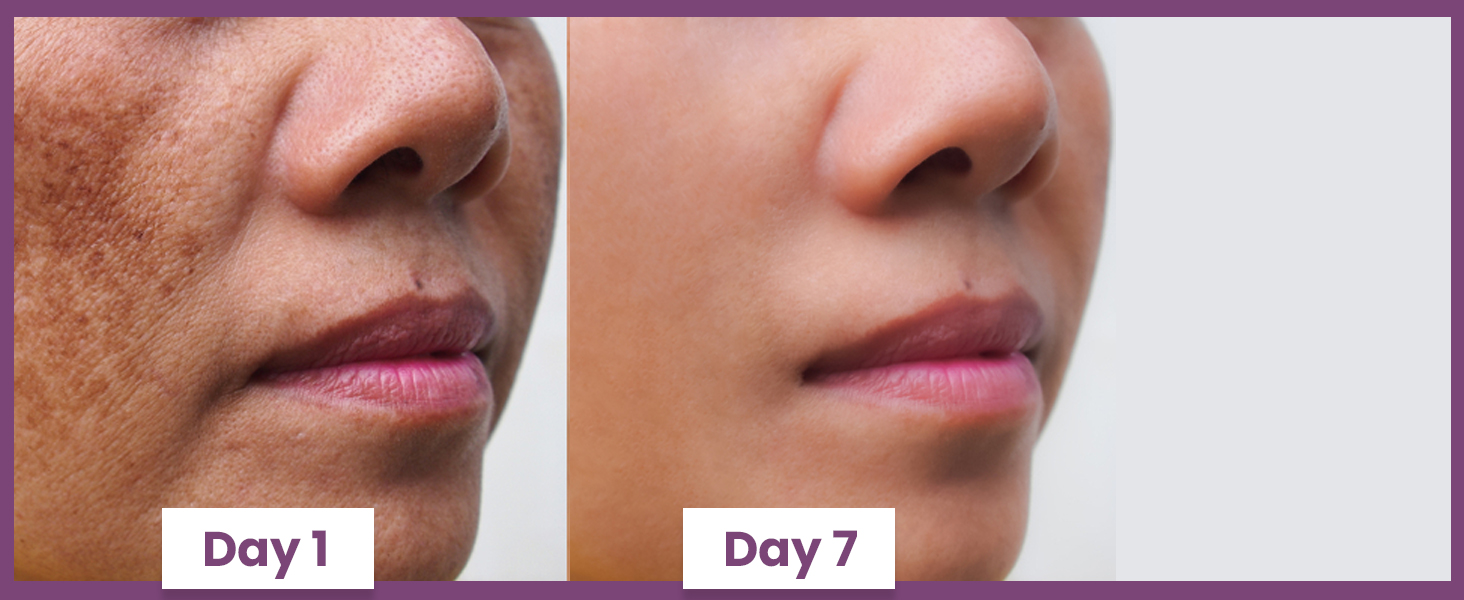 Breakouts and Dark Spots