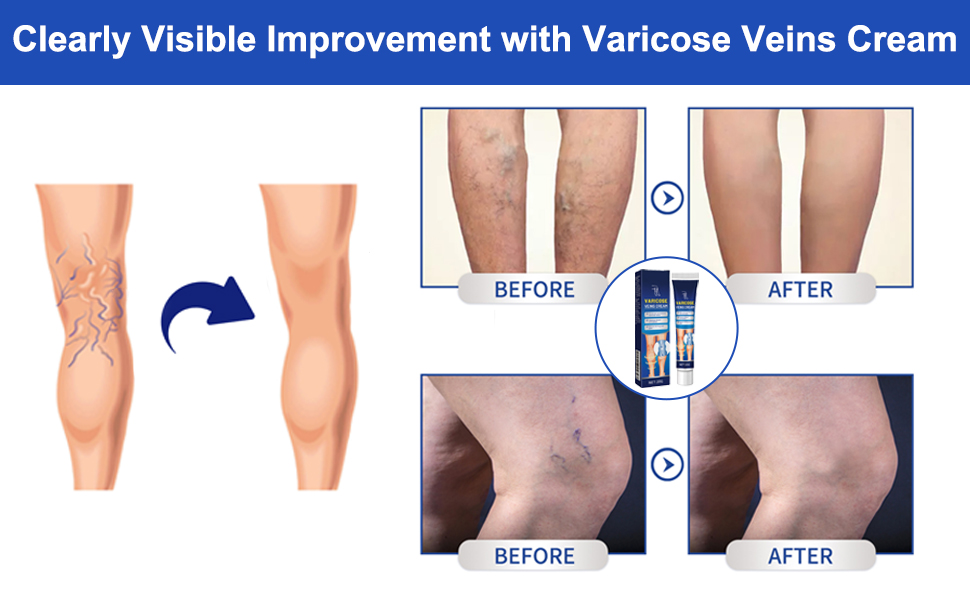 varicose vein cream