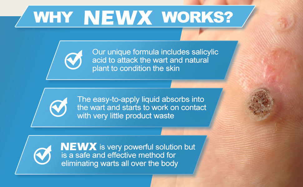 NEWX WART REMOVER WORKS
