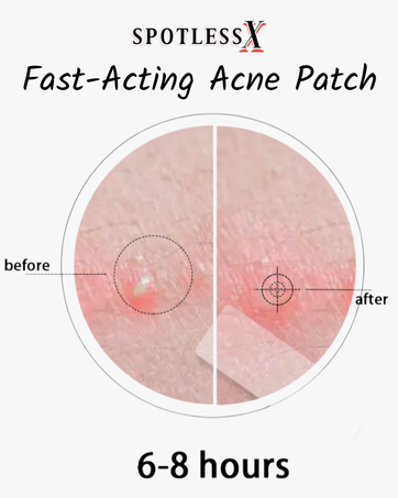 SpotlessX miracle acne patch pimple sticker cover