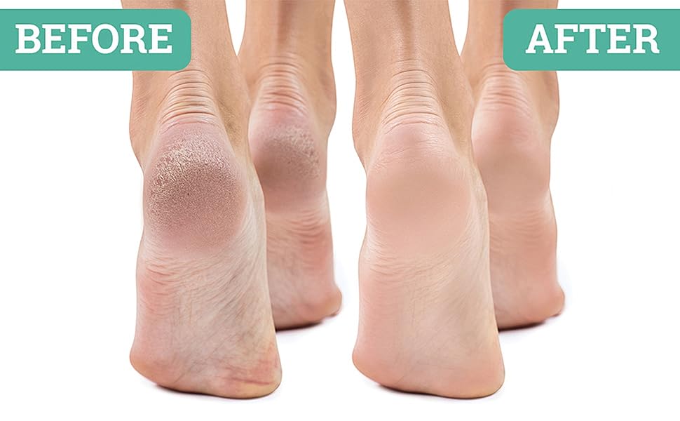 Foot Care Cream Cracked Feet