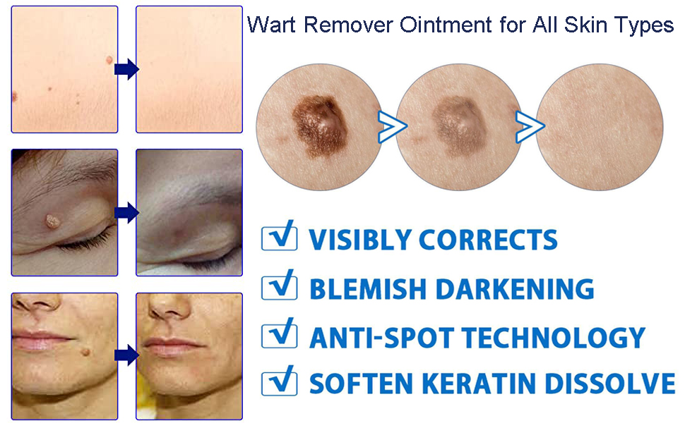 WartsOff Instant Blemish Rémoval Cream