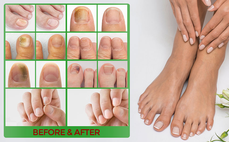 XL TOE JAM JUNIPER by FOOT DOPE Toenail Fungus Treatment