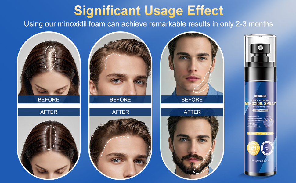 extra strength minoxidil