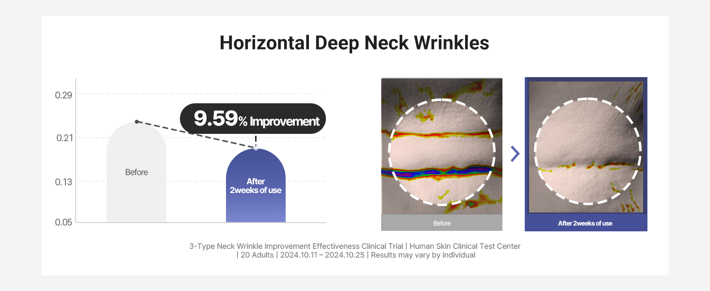 Horizontal Neck Wrinkle