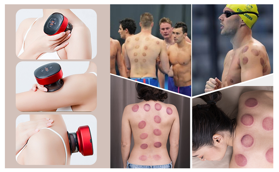 Smart Cupping