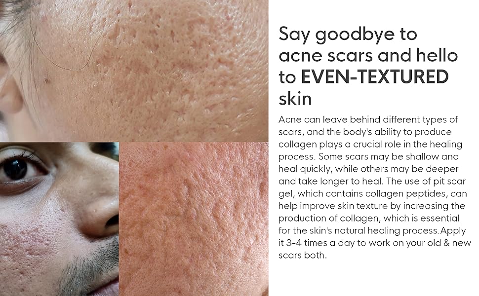 I Am Love Pit Scar Gel For Acne Scar Removal, Anti Acne Gel Helps