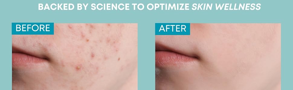 before and after pictures from an acne face wash with 5% benzoyl peroxide