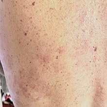shingles rash day 10