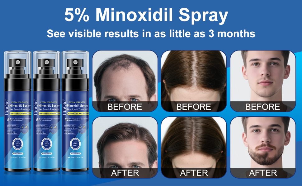 minoxidil for men minoxidil minoxidil for women for minoxidil minoxidil for women hair growth
