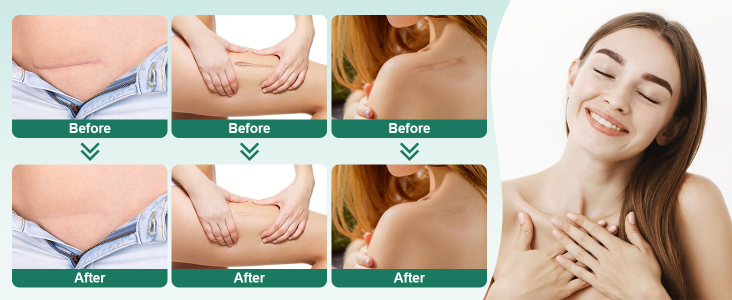 Grade Silicone Scar Sheets