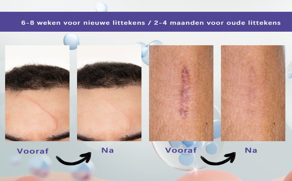 Verzorgingscrème voor littekens