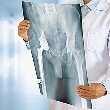 total hip replacement surgery knee back hospital xray doctor medical