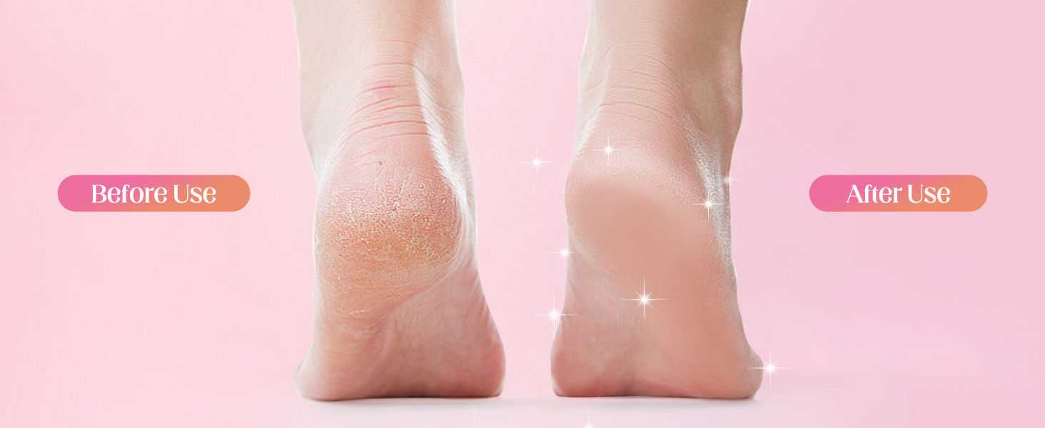 electric callus remover for feet