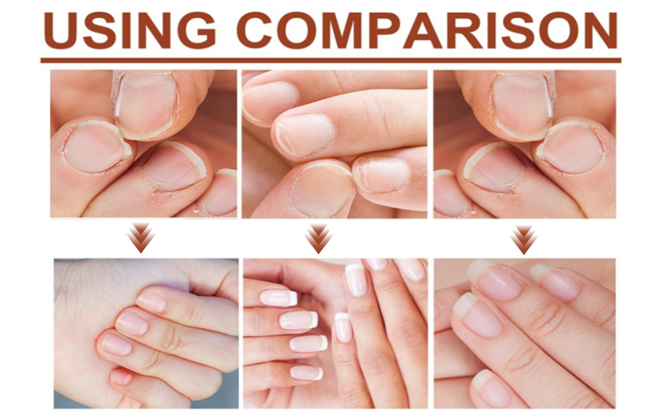 GFOUK 7 Days Nail Growth and Strengthening Serum, Nail Serum for