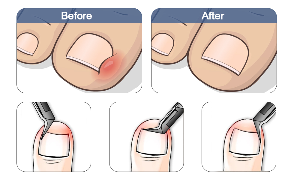  Ingrown Toenail Clippers