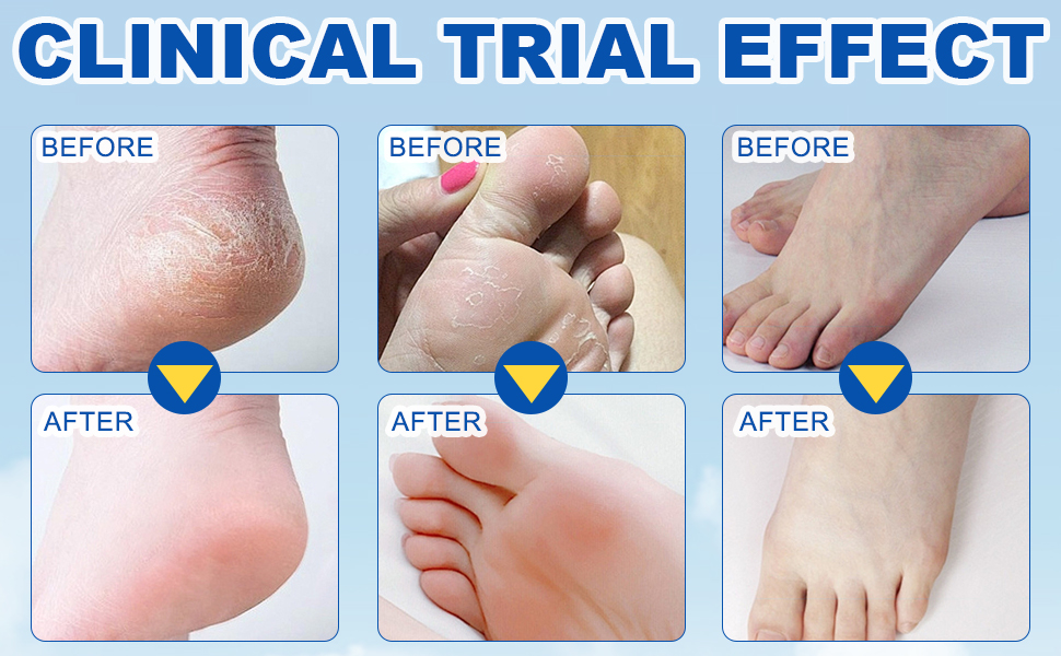 60% Urea with 2% Salicylic Acid Urea Foot Care Stick