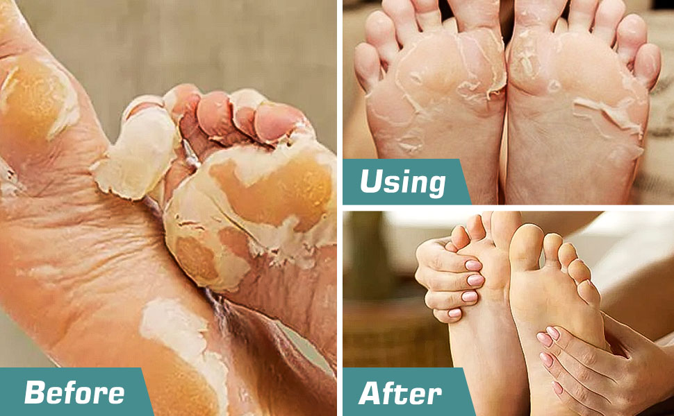  Electric Foot Callus Remover for Feet