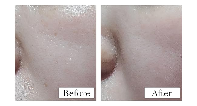 Visibly better results on wrinkle improvements on elevens smile lines cheeks around mouth lips