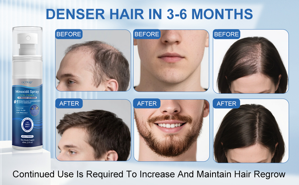 5% Minoxidil for Men and Women, Regrowth Serum, Extra Strength Spray for Hair Loss