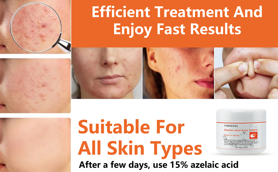 Azelaic Acid Acne Cream With Aloe Extract