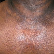 Neck/Chest Area