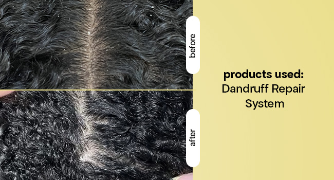 dandruff shampoo