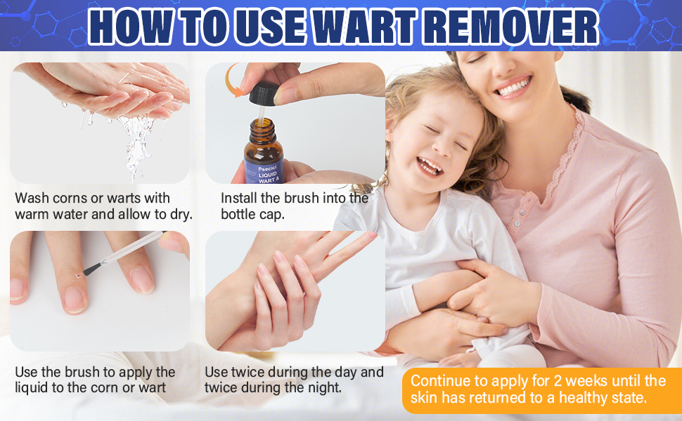 wart removal