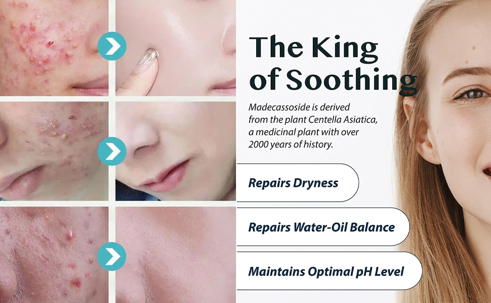 Azelaic Acid Acne Cream With Aloe Extract