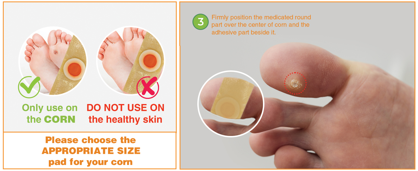 Samsali Corn Remover, Corn Feet Remover, 42 Corn Remover