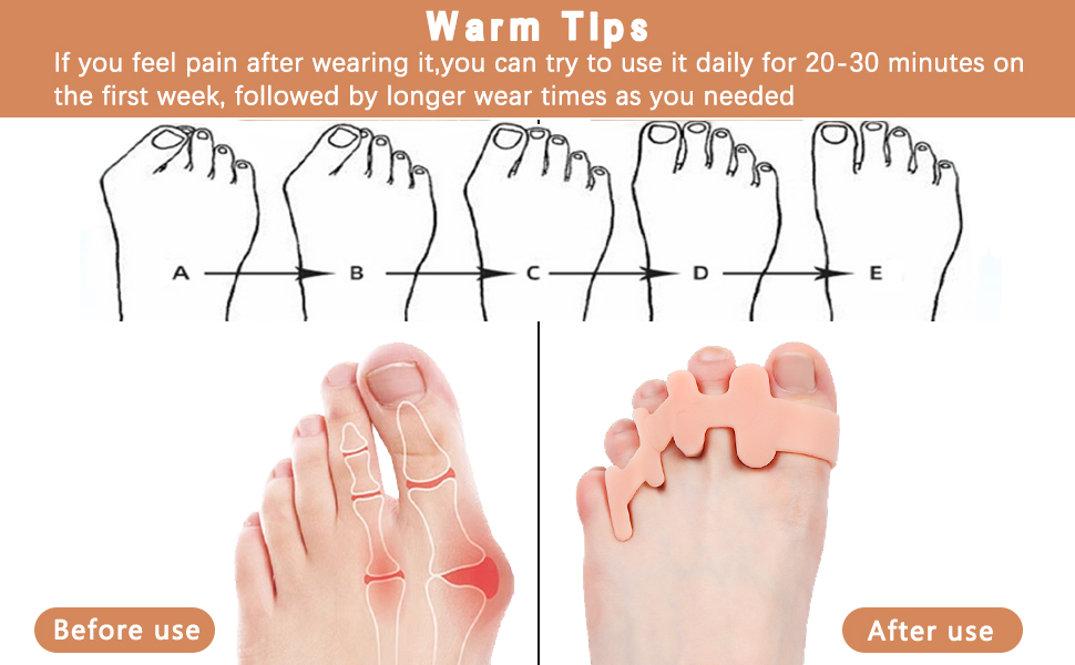  Correcting Bunions and Restoring Toes