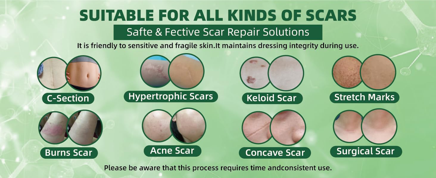 Silicone Scar Sheets