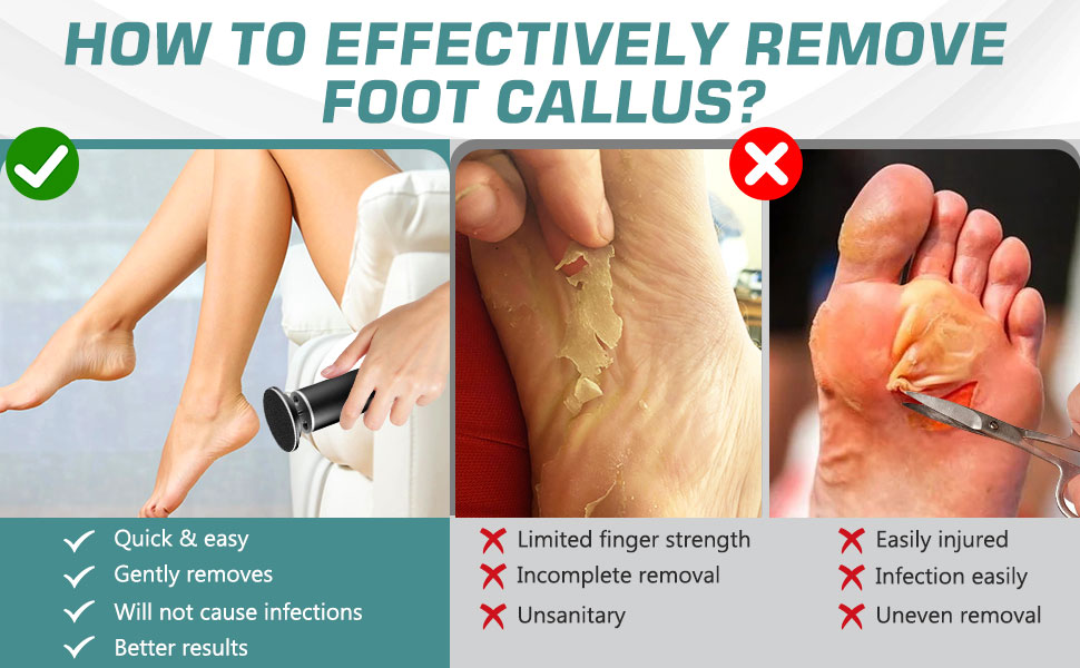  Electric Foot Callus Remover for Feet