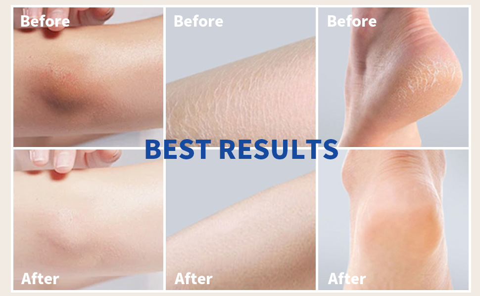 urea; heel cream for dry cracked feet; foot cream for calluses and dry feet;