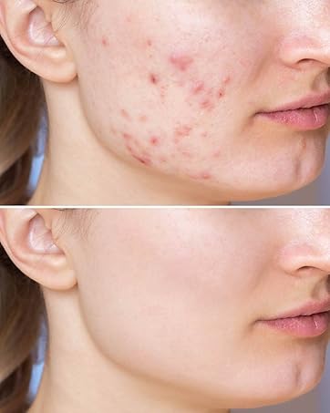 acne support, blemishes