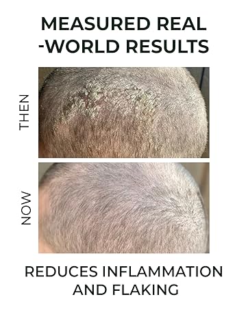 Seborrhoeic serum Atoskin