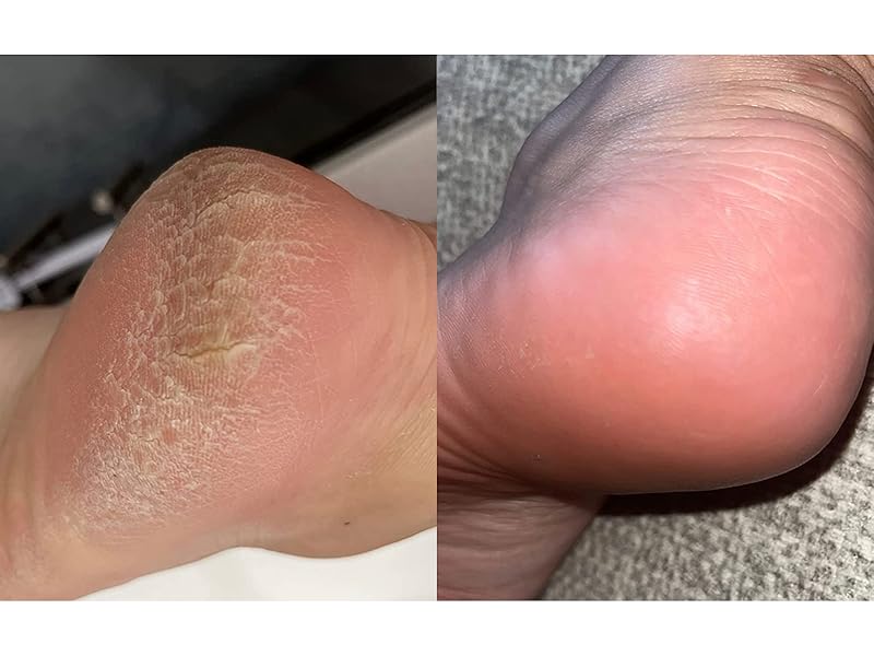Before and after results from Plantifique customer after using the foot peel mask for cracked heels