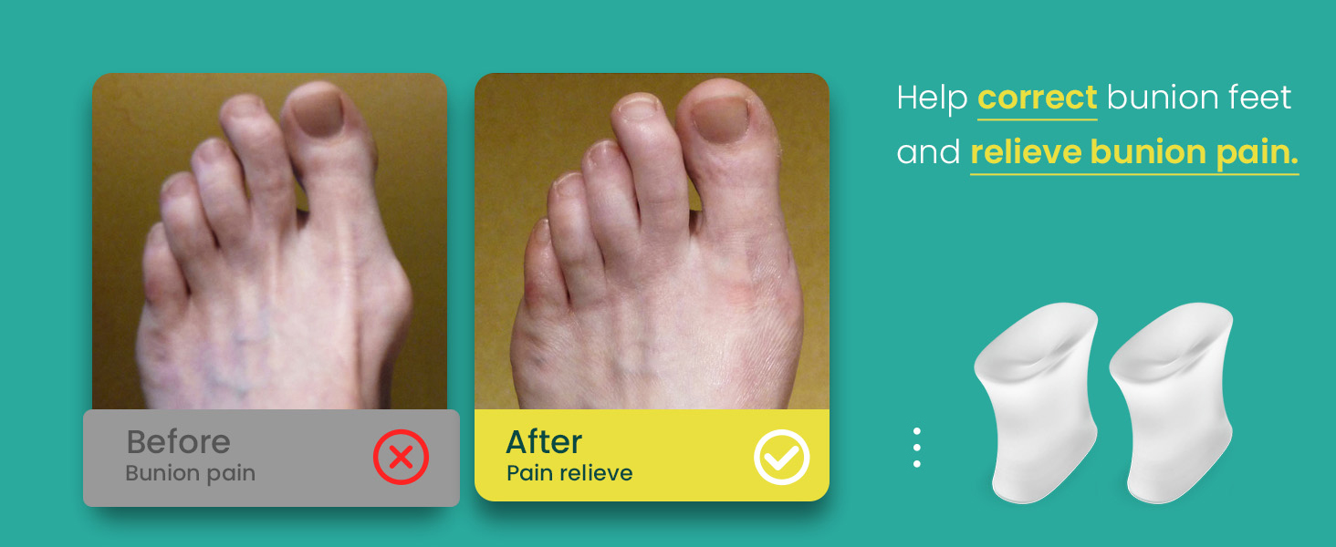 Welnove Upgraded Gel Toe Separators 12Pack Aloe Vera