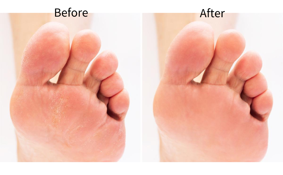 Extra Coarse Foot File Replacement Rollers, 5pcs Callus Remover Refill