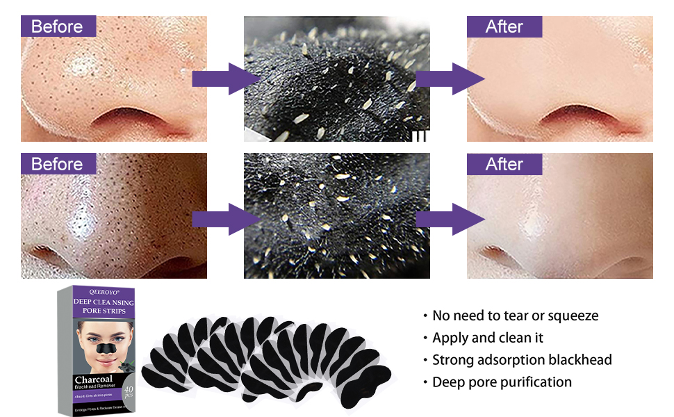 Nosestripes Blackheads, Mitesser Strips, Nasenstrips für Männer, MitesserStreifen, Entfernen