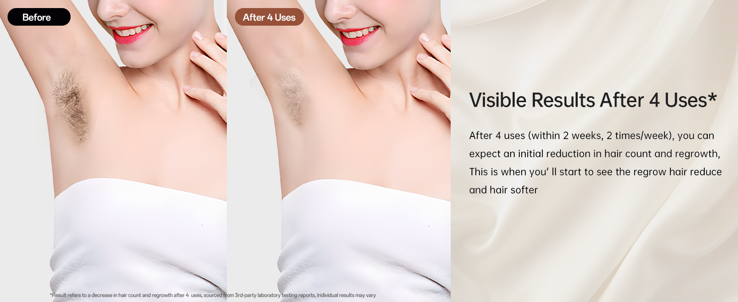 Laser Hair Removal Device for Women and Men 11 b6920571 e139 4591 8964 f876231c5068. CR0,0,1464,600 PT0 SX1464 V1