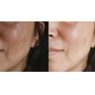 dullness in the skin