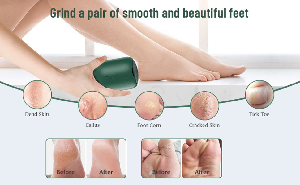 electric foot callus remover