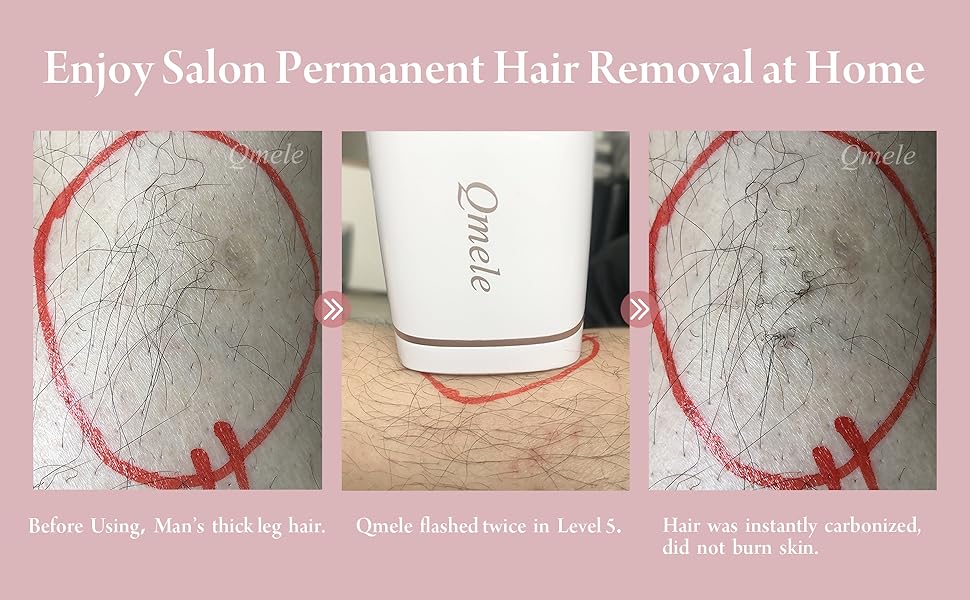 hair removal device