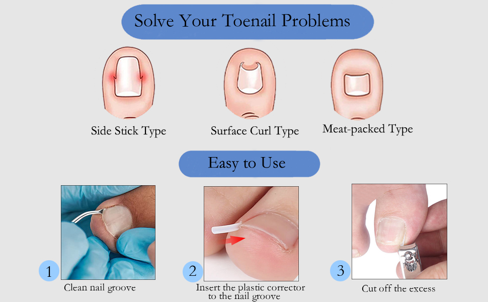 Ingrown Toenail Corrector