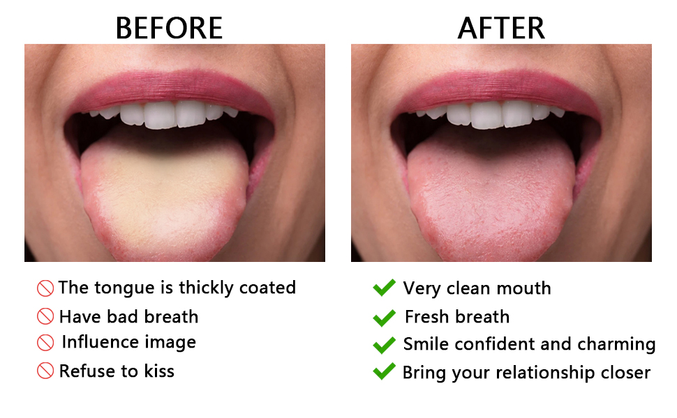 2Pcs Stainless Steel Tongue Scrapers,U Shaped Tung Scraper