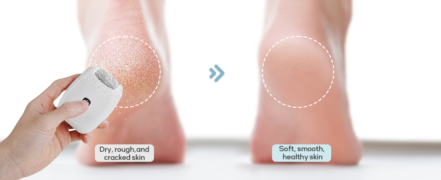 dermave electric foot callus remover